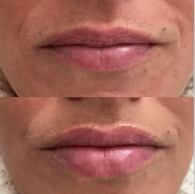 Close-up of lips before and after a cosmetic procedure, showing smoother skin and fuller appearance after treatment.